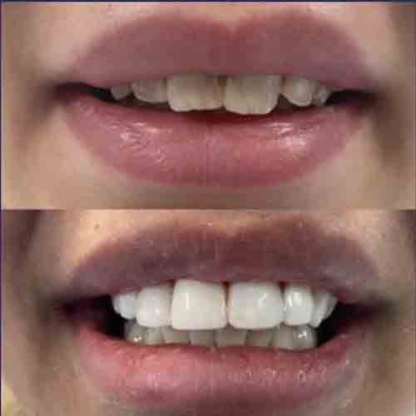 Composite Bonding Gallery Composite Bonding Gallery